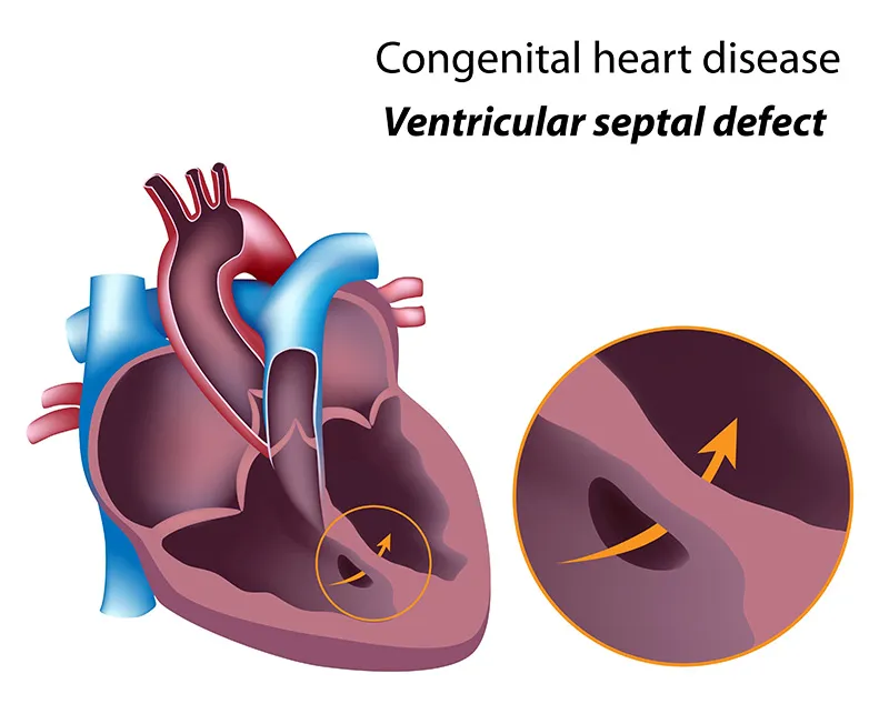 Cyanotic Heart Disease