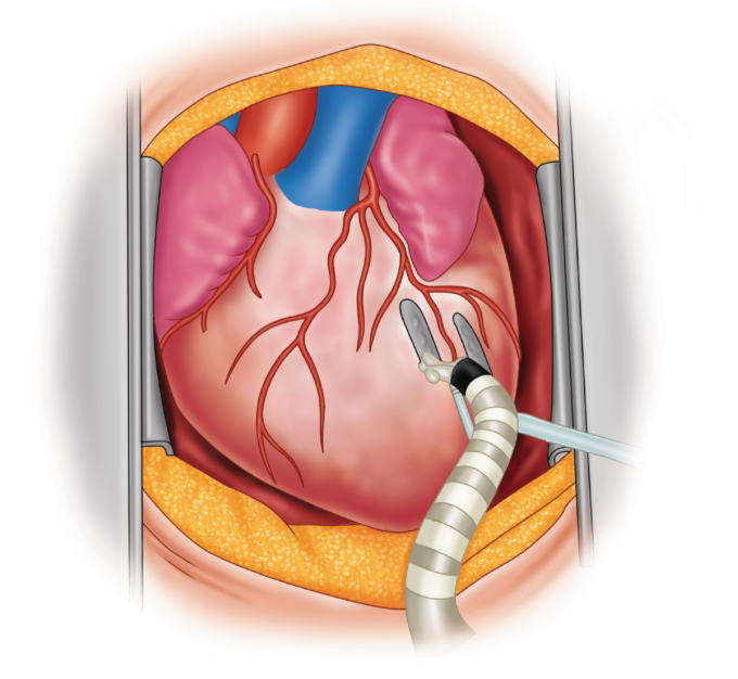 Beating-Heart Bypass Surgery