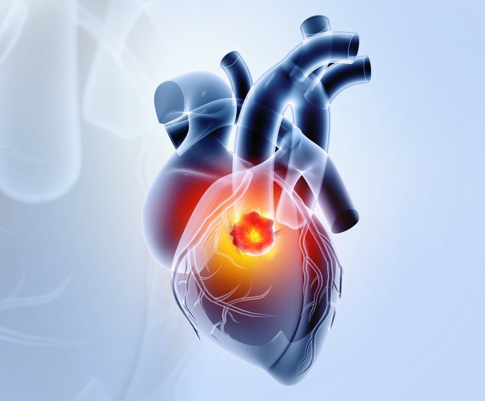 Cardiac Tumors and RSOV