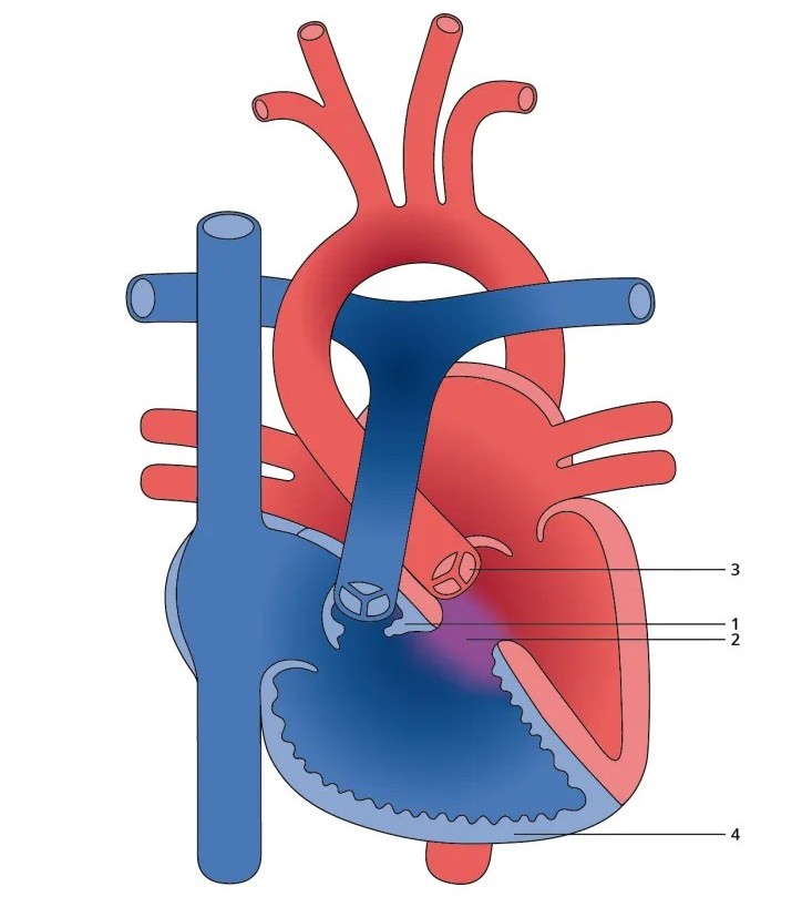 Acyanotic Heart Disease