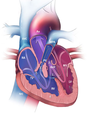 Complex Congenital Heart Disease (Complex CHD)