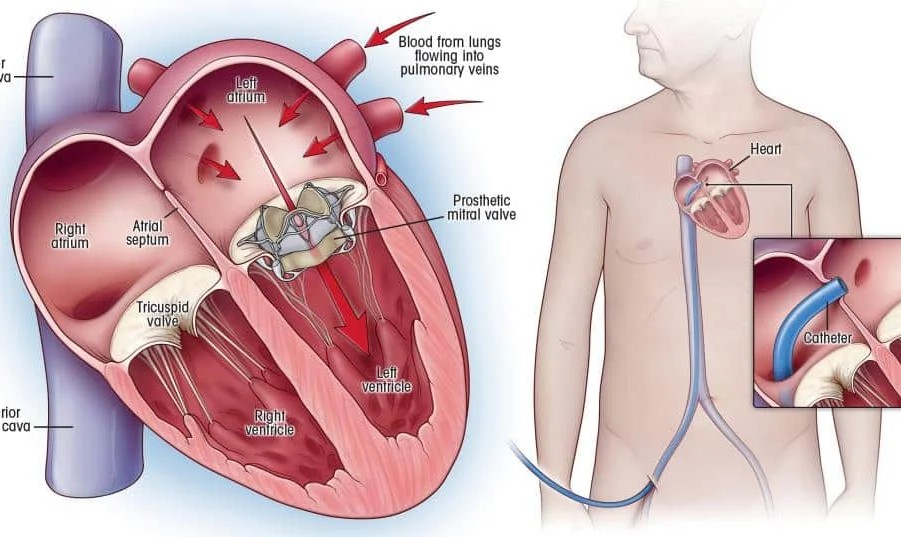 Understanding Heart Valves