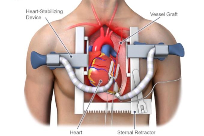 Minimally Invasive Cardiac Surgery