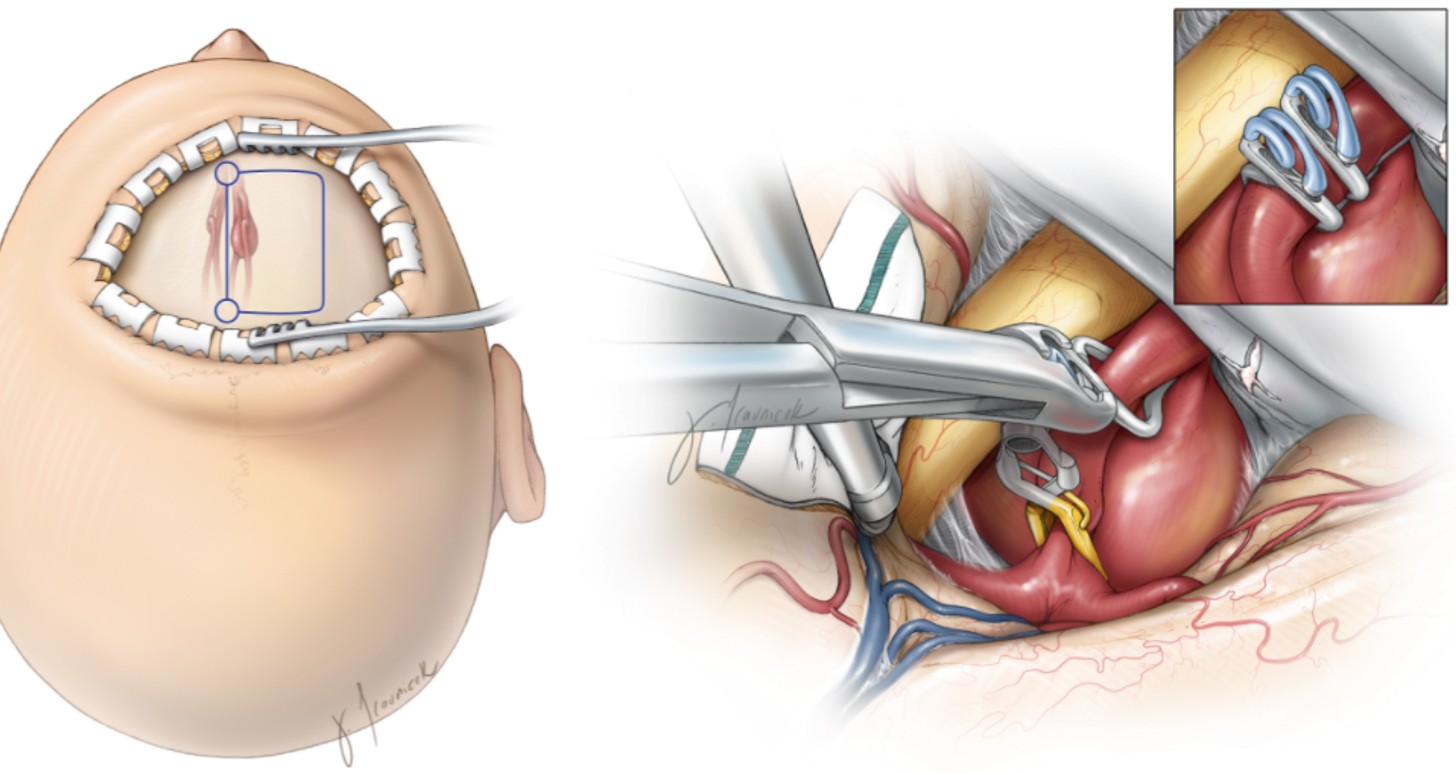 Surgery for Aneurysms