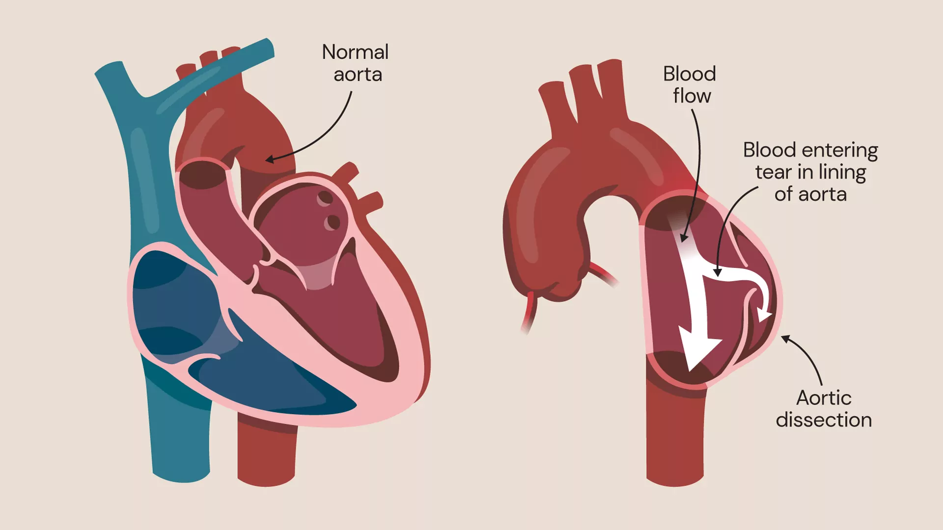 Aortic Dissections