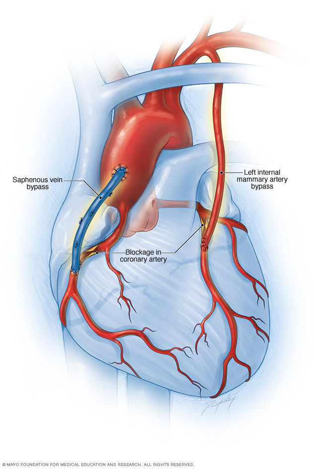 Coronary Artery Bypass Grafting (CABG)