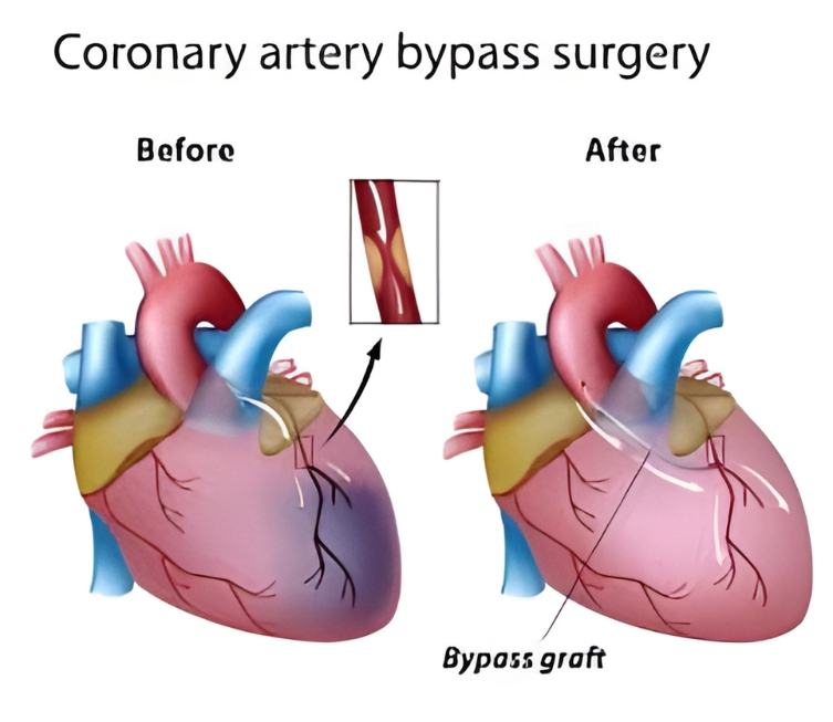 Acyanotic Heart Disease