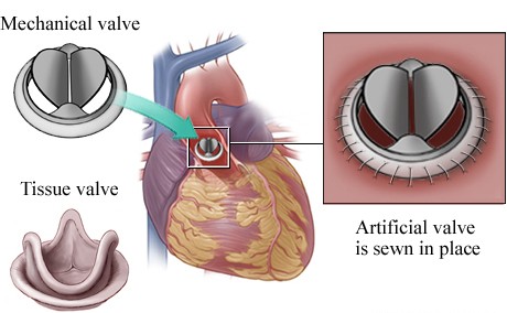 Heart Valve Replacement