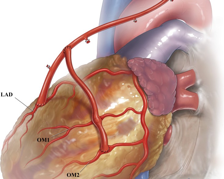 Total Arterial CABG Surgery