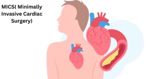 (Minimally Invasive Cardiac Surgery) MICS