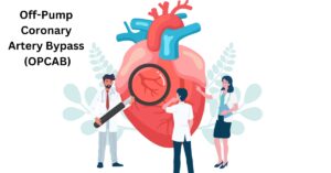 Off-Pump Coronary Artery Bypass (OPCAB)